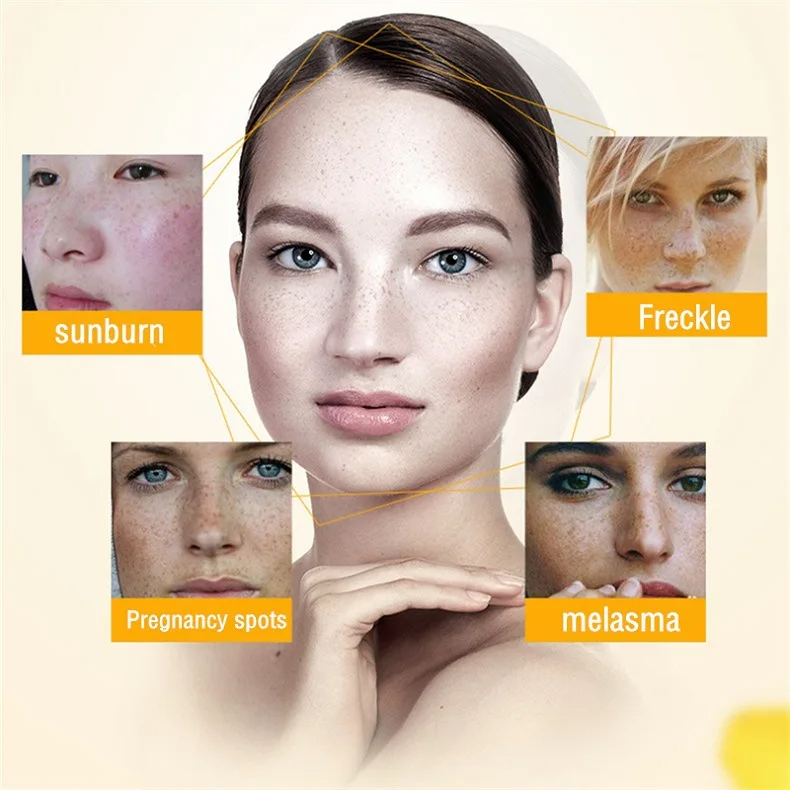 Whitening Freckle Cream Remove - Retinol Cream review and price