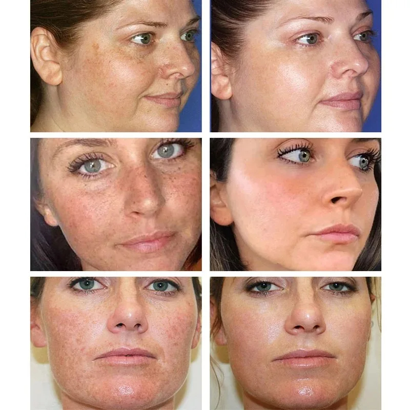 Whitening Freckle Cream Remove - Retinol Cream review and price